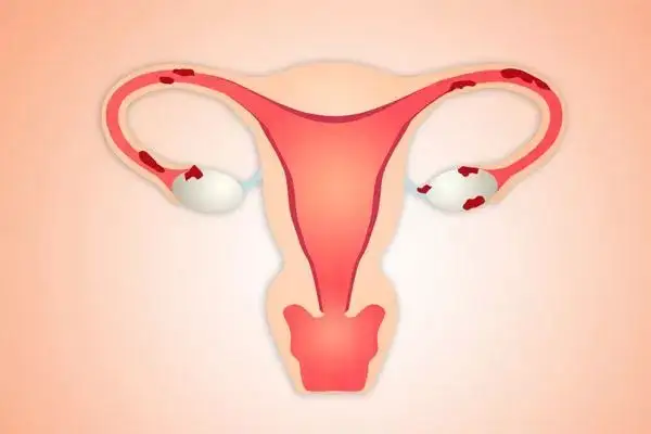 慢性输卵管卵巢炎是怎么回事