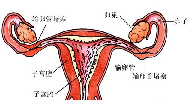 什么是双侧输卵管妊娠？
