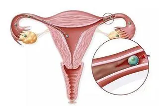 输卵管不通导致不孕不育，只能手术？不一定！