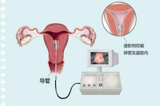 做过输卵管通液，还没怀孕，需要做输卵管造影吗？
