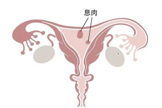子宫内膜息肉是个什么病？哪种子宫内膜息肉会发生癌变？