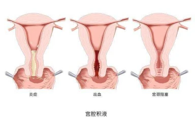 宫腔积液会影响试管婴儿正常的助孕吗？有必要治疗吗？