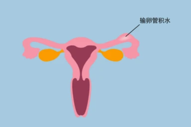 输卵管积水不处理会影响试管婴儿移植后的胚胎着床吗？