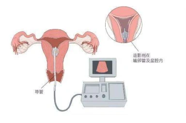 子宫输卵管造影是什么？