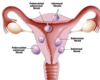 多囊卵巢综合症患者怀孕率低，与这3个因素密切相关