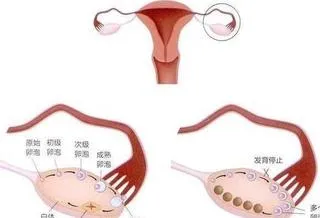 多囊卵巢的诊断与治疗