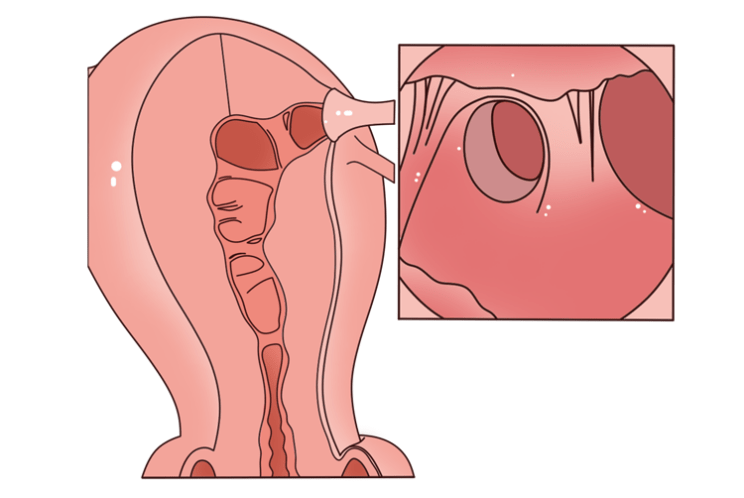 试管失败,两回胎停!四年未孕又查出甲状腺癌的她竟然怀孕了