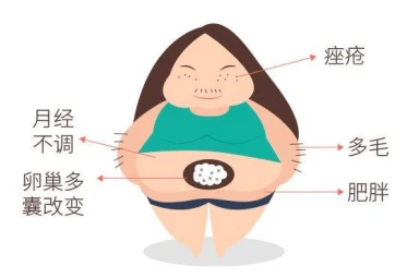 多囊卵巢综合征和肥胖到底是什么关系？