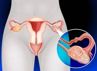 子宫腺肌症怀孕不易！多数女性需借助试管生育