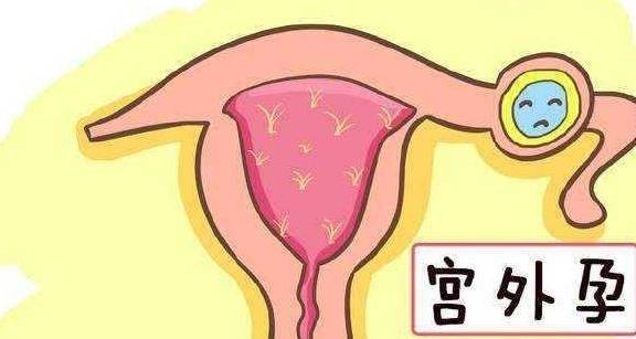 宫外孕让怀孕喜事变丧事,男性这3种行为可能是凶手,别大意 宫外孕让怀孕喜事变丧事,男性这3种行为可能是凶手,别大意