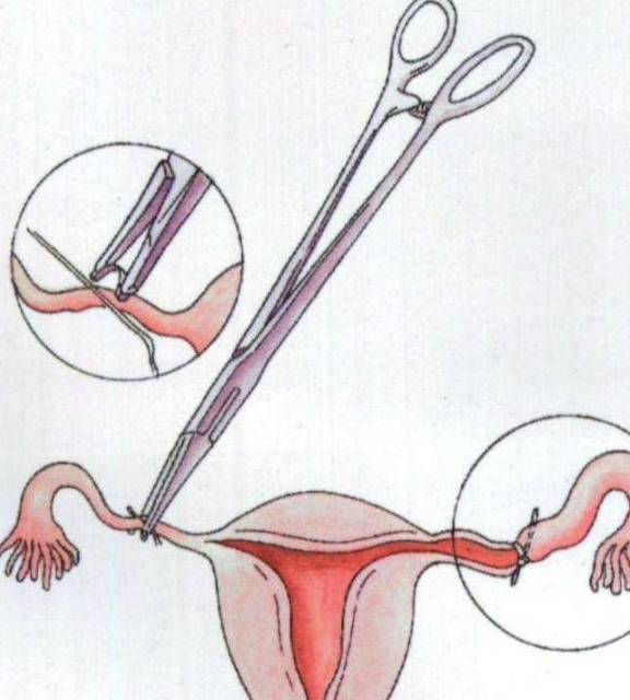 宫外孕让怀孕喜事变丧事,男性这3种行为可能是凶手,别大意 宫外孕让怀孕喜事变丧事,男性这3种行为可能是凶手,别大意