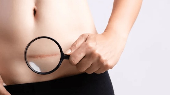 剖腹产多少天可以洗澡,真相了 剖腹产多少天可以洗澡,真相了