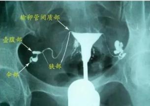 输卵管粘连,还能自然怀孕吗? 输卵管粘连,还能自然怀孕吗?