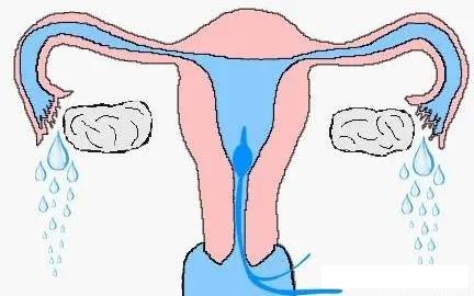 检查输卵管是否通畅,选择通液还是造影呢? 检查输卵管是否通畅,选择通液还是造影呢?