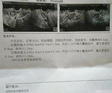 什么?多囊卵巢 ≠ 多囊卵巢综合征 什么?多囊卵巢 ≠ 多囊卵巢综合征