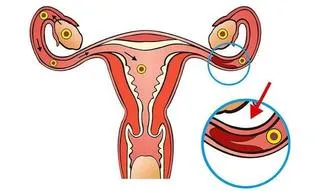 女性出现输卵管堵塞怎么办？