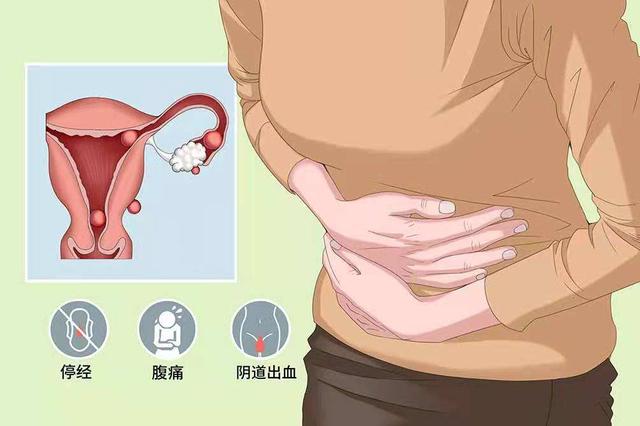 什么是盆腔积液,主要是哪些因素引起的疾病?警惕病理性因素 什么是盆腔积液,主要是哪些因素引起的疾病?警惕病理性因素