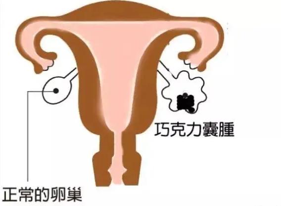 巧克力囊肿对做试管会有影响吗? 巧克力囊肿对做试管会有影响吗?