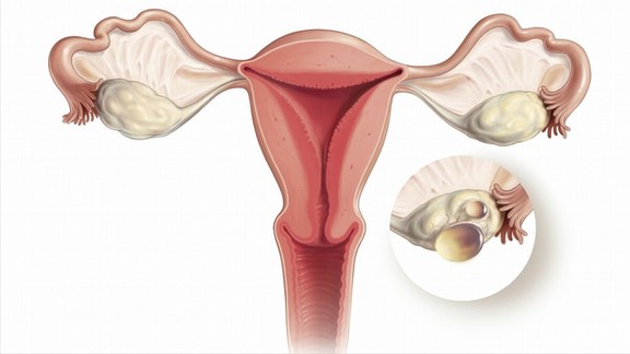 妇科体检时发现卵巢囊肿怎么办?一定要切除吗? 妇科体检时发现卵巢囊肿怎么办?一定要切除吗?