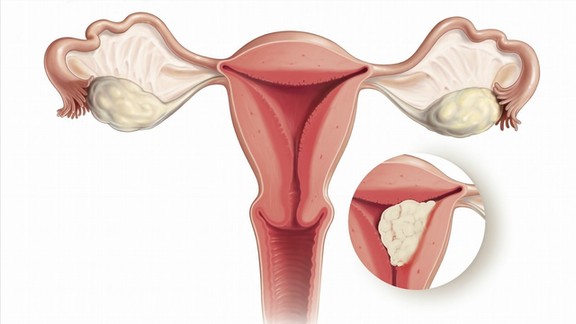 妇科体检时发现卵巢囊肿怎么办?一定要切除吗? 妇科体检时发现卵巢囊肿怎么办?一定要切除吗?