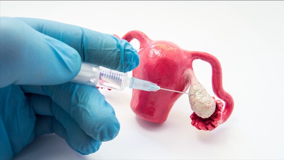 妇科体检时发现卵巢囊肿怎么办?一定要切除吗? 妇科体检时发现卵巢囊肿怎么办?一定要切除吗?