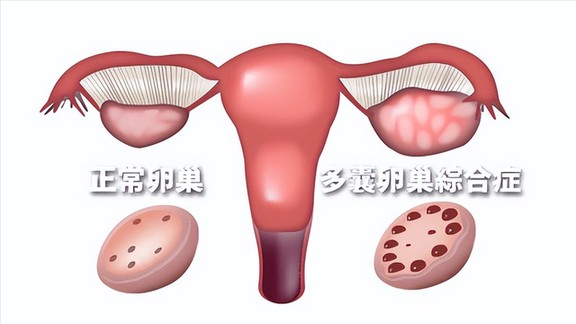 什么是“巧克力囊肿”?与多囊卵巢综合征究竟是不是一回事儿? 什么是“巧克力囊肿”?与多囊卵巢综合征究竟是不是一回事儿?