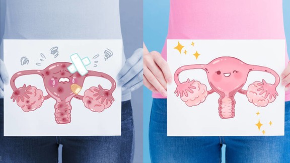 什么是“巧克力囊肿”?与多囊卵巢综合征究竟是不是一回事儿? 什么是“巧克力囊肿”?与多囊卵巢综合征究竟是不是一回事儿?