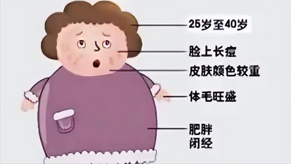 什么是“巧克力囊肿”?与多囊卵巢综合征究竟是不是一回事儿? 什么是“巧克力囊肿”?与多囊卵巢综合征究竟是不是一回事儿?