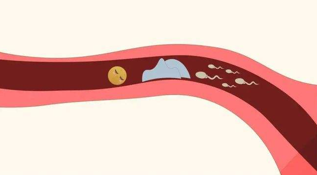 左侧输卵管积水的症状有哪些? 左侧输卵管积水的症状有哪些?