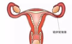 女性输卵管堵塞的危害是什么？