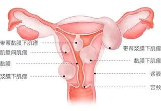 子宫腺肌症、子宫内膜异位症、子宫肌瘤，有什么区别？