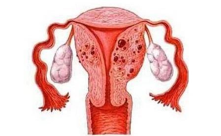 子宫腺肌症、子宫内膜异位症、子宫肌瘤,傻傻分不清楚? 子宫腺肌症、子宫内膜异位症、子宫肌瘤,傻傻分不清楚?