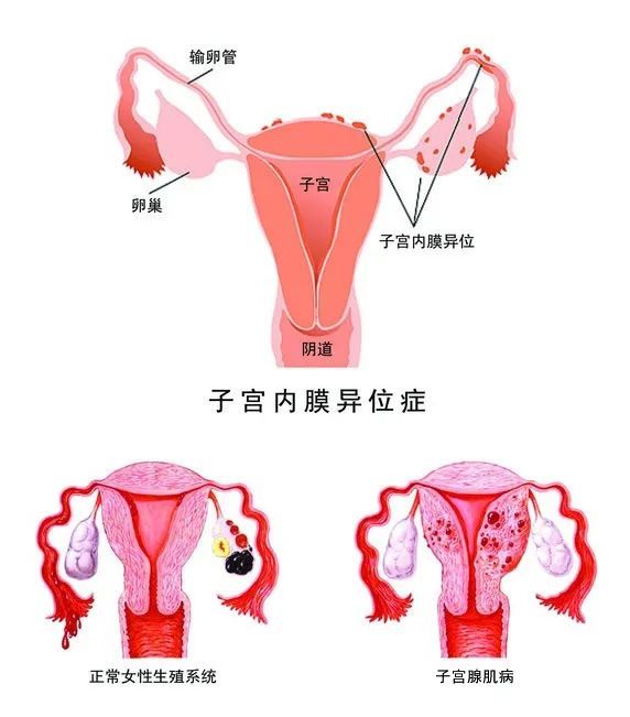 子宫腺肌症、子宫内膜异位症、子宫肌瘤,傻傻分不清楚? 子宫腺肌症、子宫内膜异位症、子宫肌瘤,傻傻分不清楚?