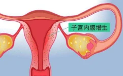 子宫内膜增生的饮食保健