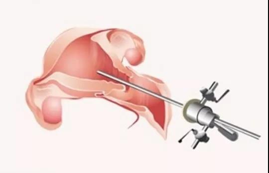 试管婴儿从促排到验孕要花多少钱？