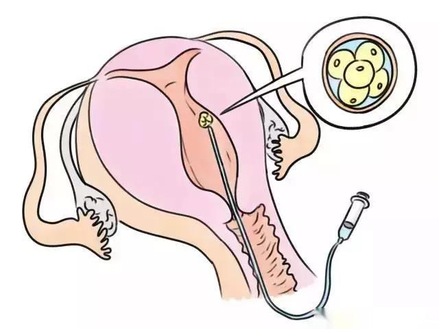 胚胎移植前为什么要先憋尿？