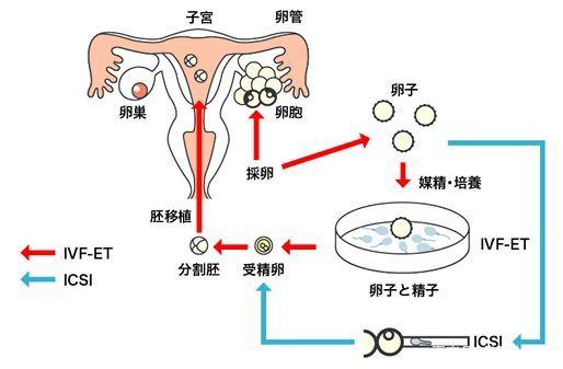 试管攻略｜试管婴儿胚胎移植1个好还是2个好？
