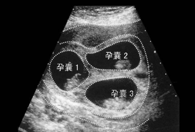 试管双胞胎是如何减少婴儿数量的 试管双胞胎是如何减少婴儿数量的