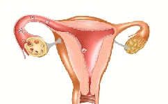 多囊卵巢综合征可以被治愈吗？