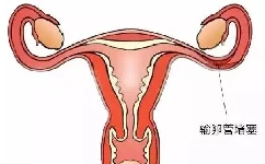 女性输卵管不孕怎么办？