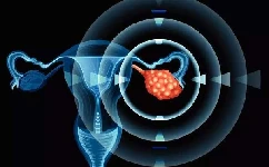 患上卵巢癌身体会怎么样？