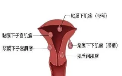 子宫肌瘤有哪些明显的症状表现？
