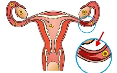 输卵管通而不畅能怀孕吗？