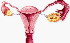 子宫内膜异位是怎么回事？