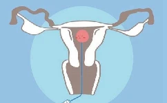 子宫肌瘤会导致不孕吗？