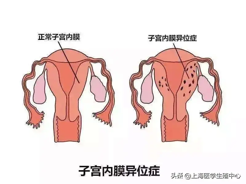 女性朋友得了子宫内膜异位症,还能怀孕吗? 女性朋友得了子宫内膜异位症,还能怀孕吗?