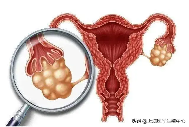 女性朋友得了子宫内膜异位症,还能怀孕吗? 女性朋友得了子宫内膜异位症,还能怀孕吗?