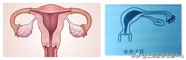 单角子宫能怀孕吗? 单角子宫能怀孕吗?