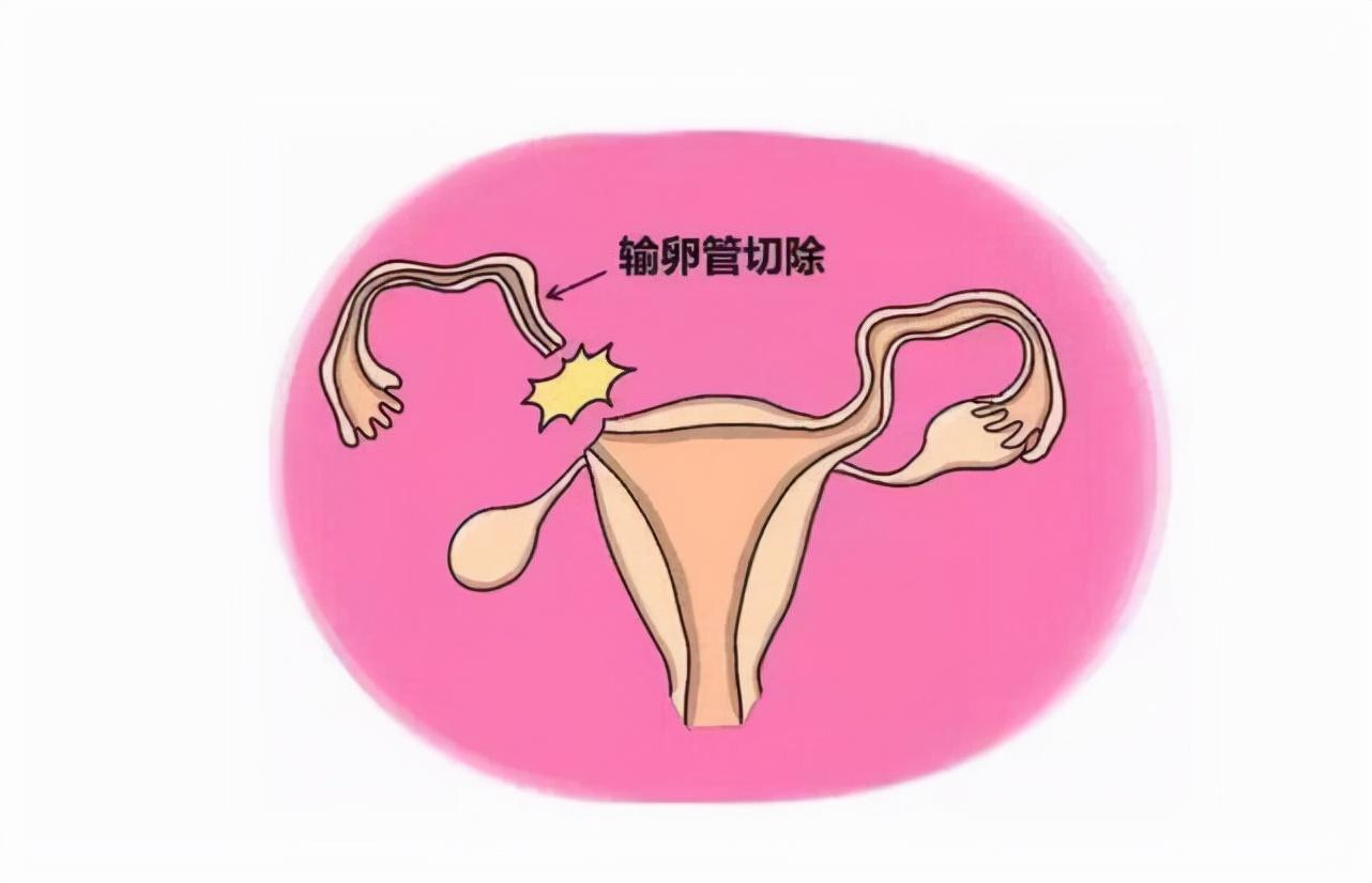 切除输卵管还能生育吗？