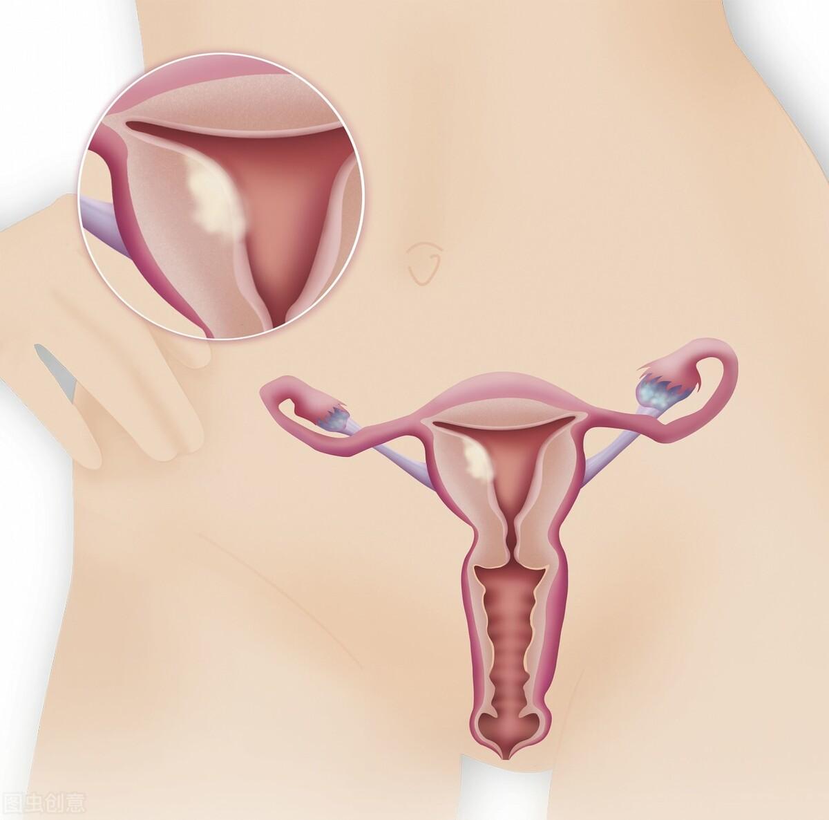 子宫内膜薄一点好,还是厚一点好? 子宫内膜薄一点好,还是厚一点好?